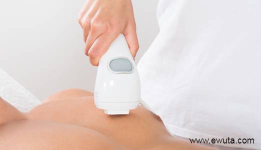 laser hair removal