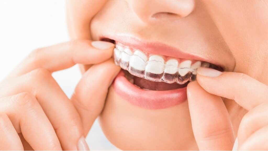 Invisalign Treatment